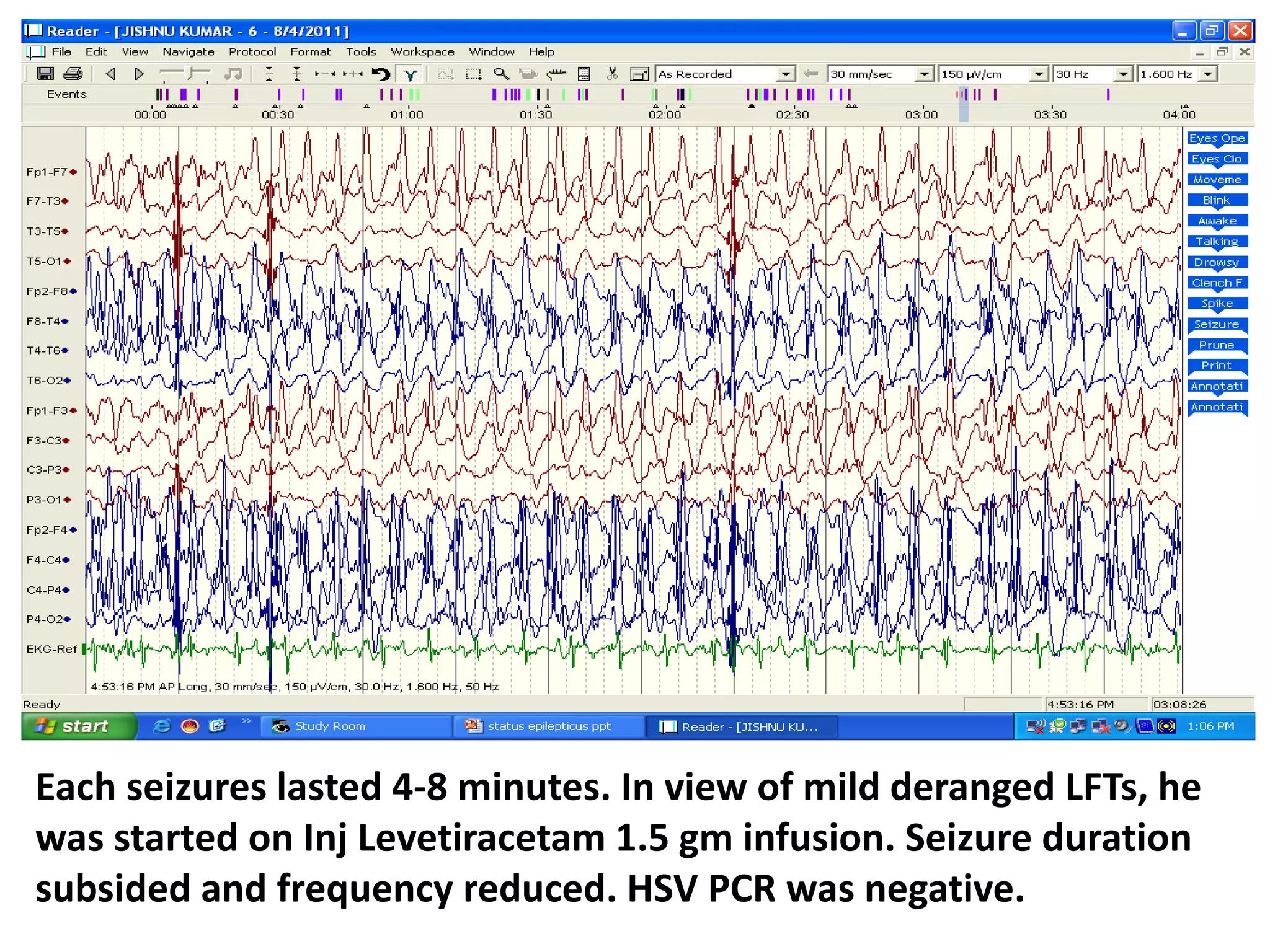 Each seizures lasted 4-8 minutes. In view of mild deranged LFTs, he
was started on Inj Levetiracetam 1.5 gm infusion. Seizure duration
subsided and frequency reduced. HSV PCR was negative.
 