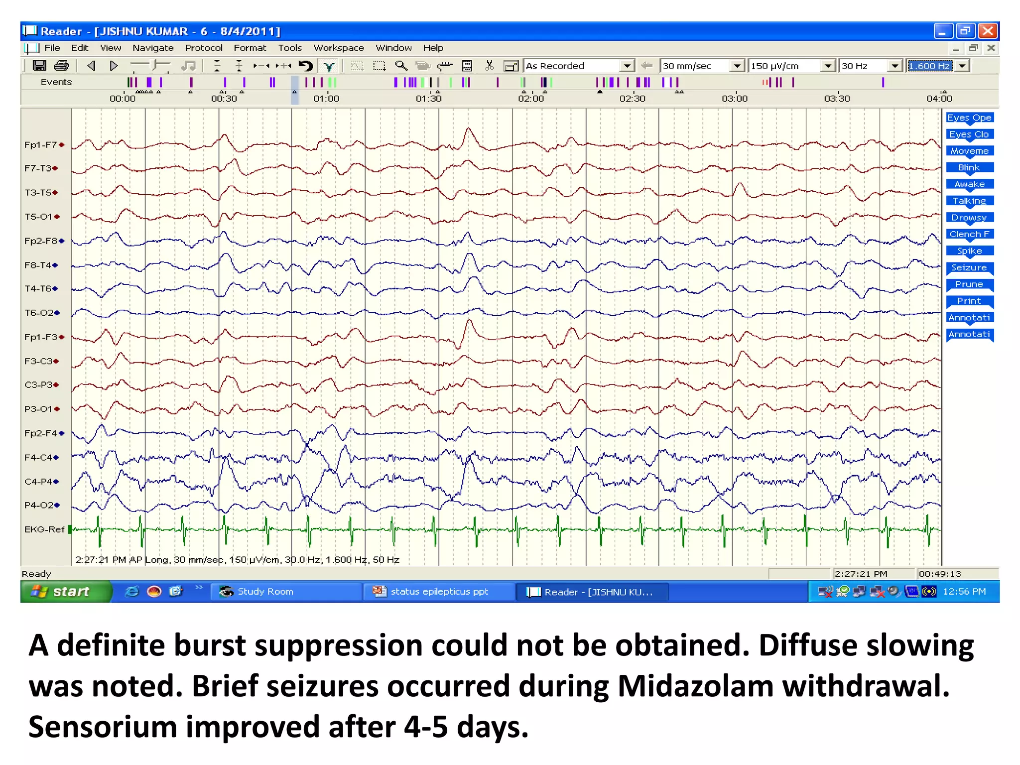 A definite burst suppression could not be obtained. Diffuse slowing
was noted. Brief seizures occurred during Midazolam withdrawal.
Sensorium improved after 4-5 days.
 