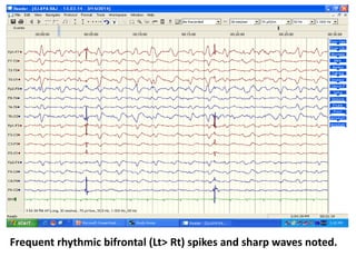 Frequent rhythmic bifrontal (Lt> Rt) spikes and sharp waves noted.
 