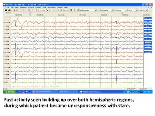 Fast activity seen building up over both hemispheric regions,
during which patient became unresponsiveness with stare.
 