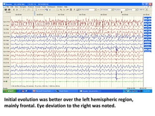 Initial evolution was better over the left hemispheric region,
mainly frontal. Eye deviation to the right was noted.
 