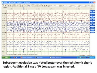 Subsequent evolution was noted better over the right hemispheric
region. Additional 3 mg of IV Lorazepam was injected.
 