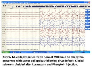 23 yrs/ M, epilepsy patient with normal MRI brain on phenytoin
presented with status epilepticus following drug default. Clinical
seizures subsided after Lorazepam and Phenytoin injection.
 