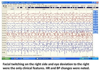 Facial twitching on the right side and eye deviation to the right
were the only clinical features. HR and BP changes were noted.
 