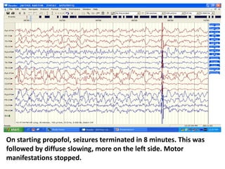 On starting propofol, seizures terminated in 8 minutes. This was
followed by diffuse slowing, more on the left side. Motor
manifestations stopped.
 