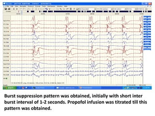 Burst suppression pattern was obtained, initially with short inter
burst interval of 1-2 seconds. Propofol infusion was titrated till this
pattern was obtained.
 