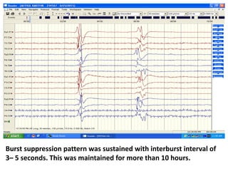 Burst suppression pattern was sustained with interburst interval of
3– 5 seconds. This was maintained for more than 10 hours.
 