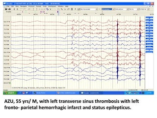 AZU, 55 yrs/ M, with left transverse sinus thrombosis with left
fronto- parietal hemorrhagic infarct and status epilepticus.
 