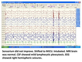 Sensorium did not improve. Shifted to MICU. Intubated. MRI brain
was normal. CSF showed mild lymphocytic pleocytosis. EEG
showed right hemispheric seizures.
 