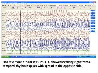 Had few more clinical seizures. EEG showed evolving right fronto-
temporal rhythmic spikes with spread to the opposite side.
 