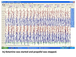 Inj Ketamine was started and propofol was stopped.
 