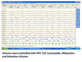 Seizures were controlled with PHT, LEV, Lacosamide, Midazolam
and Ketamine infusion.
 