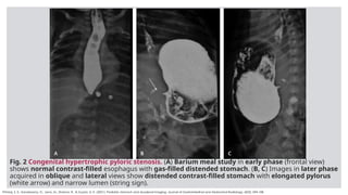 Pediatric Stomach and Duodenal Imaging copy.pptx