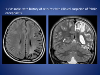 13 yrs male, with history of seizures with cilinical suspicion of febrile
encephalitis.
 