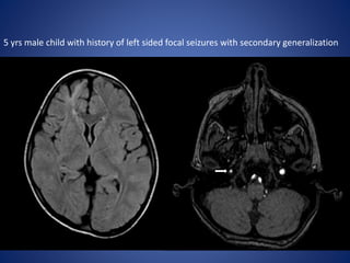 5 yrs male child with history of left sided focal seizures with secondary generalization
 