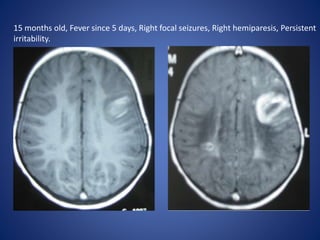 15 months old, Fever since 5 days, Right focal seizures, Right hemiparesis, Persistent
irritability.
 