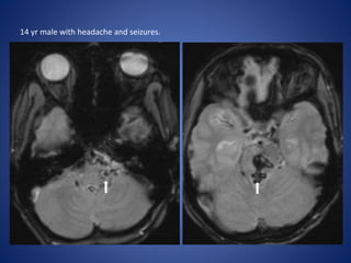 14 yr male with headache and seizures.
 