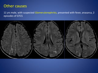 Other causes
11 yrs male, with suspected Glomerulonephritis, presented with fever, anasarca, 2
episodes of GTCS
 