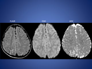 FLAIR DWI ADC
 