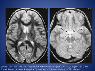 Cerebral Embolism From Atrial Myxoma in Pediatric Patients. Majeed Al-Mateen, Margaret Hood, Don
Trippel, Samuel J. Insalaco, Randolph K. Otto and Kari J. Vitikainen. Pediatrics 2003;112;e162.
 