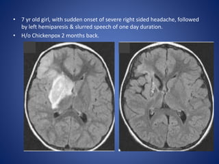 • 7 yr old girl, with sudden onset of severe right sided headache, followed
by left hemiparesis & slurred speech of one day duration.
• H/o Chickenpox 2 months back.
 