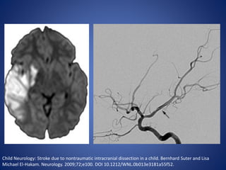 Child Neurology: Stroke due to nontraumatic intracranial dissection in a child. Bernhard Suter and Lisa
Michael El-Hakam. Neurology. 2009;72;e100. DOI 10.1212/WNL.0b013e3181a55f52.
 