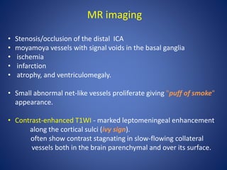 • Stenosis/occlusion of the distal ICA
• moyamoya vessels with signal voids in the basal ganglia
• ischemia
• infarction
• atrophy, and ventriculomegaly.
• Small abnormal net-like vessels proliferate giving "puff of smoke"
appearance.
• Contrast-enhanced T1WI - marked leptomeningeal enhancement
along the cortical sulci (ivy sign).
often show contrast stagnating in slow-flowing collateral
vessels both in the brain parenchymal and over its surface.
MR imaging
 