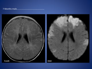 FLAIR DWI
7 Months male…………………………………………….
 