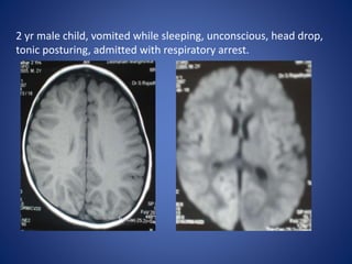 2 yr male child, vomited while sleeping, unconscious, head drop,
tonic posturing, admitted with respiratory arrest.
 