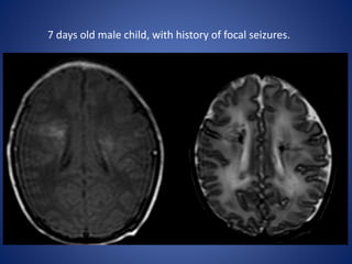 7 days old male child, with history of focal seizures.
 