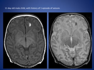 11 day old male child, with history of 1 episode of seizure.
 