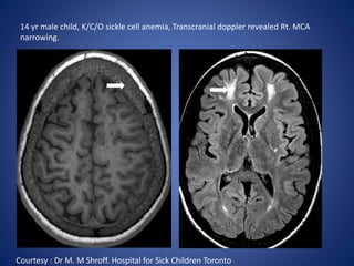 14 yr male child, K/C/O sickle cell anemia, Transcranial doppler revealed Rt. MCA
narrowing.
Courtesy : Dr M. M Shroff. Hospital for Sick Children Toronto
 