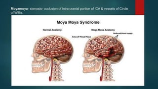 Moyamoya- stenosis- occlusion of intra cranial portion of ICA & vessels of Circle
of Willis.
 
