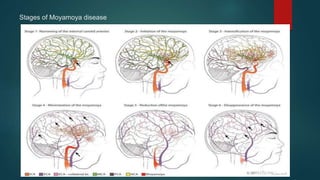 Stages of Moyamoya disease
 