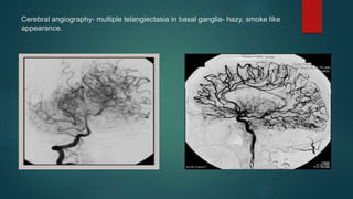 Cerebral angiography- multiple telangiectasia in basal ganglia- hazy, smoke like
appearance.
 