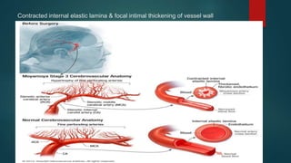 Contracted internal elastic lamina & focal intimal thickening of vessel wall
 