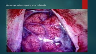 Moya moya pattern- opening up of collaterals
 