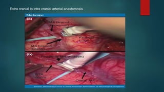 Extra cranial to intra cranial arterial anastomosis
 