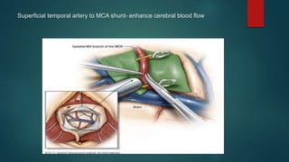 Superficial temporal artery to MCA shunt- enhance cerebral blood flow
 