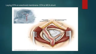 Laying STA on arachnoid membrane- STA to MCA shunt
 