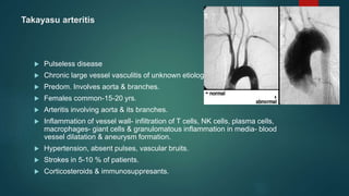 Takayasu arteritis
 Pulseless disease
 Chronic large vessel vasculitis of unknown etiology
 Predom. Involves aorta & branches.
 Females common-15-20 yrs.
 Arteritis involving aorta & its branches.
 Inflammation of vessel wall- infiltration of T cells, NK cells, plasma cells,
macrophages- giant cells & granulomatous inflammation in media- blood
vessel dilatation & aneurysm formation.
 Hypertension, absent pulses, vascular bruits.
 Strokes in 5-10 % of patients.
 Corticosteroids & immunosuppresants.
 