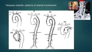 Takayasu arteritis- patterns of arterial involvement
 