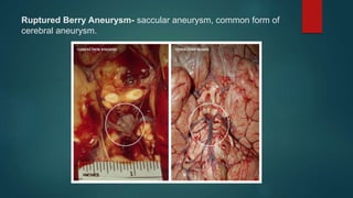 Ruptured Berry Aneurysm- saccular aneurysm, common form of
cerebral aneurysm.
 