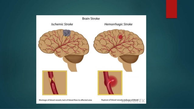 Pediatric stroke syndromes