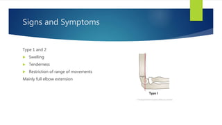 Signs and Symptoms
Type 1 and 2
 Swelling
 Tenderness
 Restriction of range of movements
Mainly full elbow extension
 