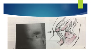  Anterior skin puckering
 