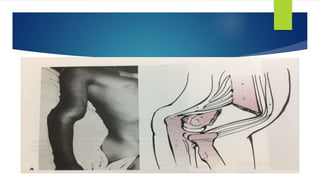  S shaped deformity
 