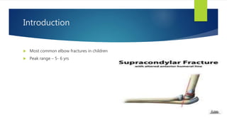 Introduction
 Most common elbow fractures in children
 Peak range – 5- 6 yrs
 
