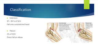 Classification
 Extension
97 – 99 % of SCH
Fall onto outstretched hand
 Flexion
2% of SCH
Direct fall on elbow
 