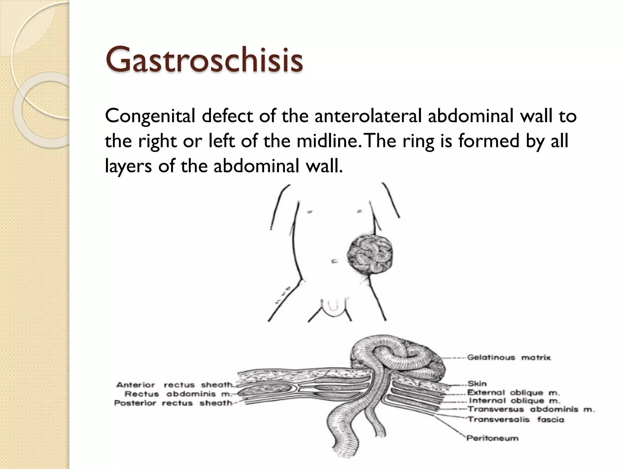 Congenital Anomalies of Anterior Abdominal wall By Dr Hatem Elgohary | PPTX